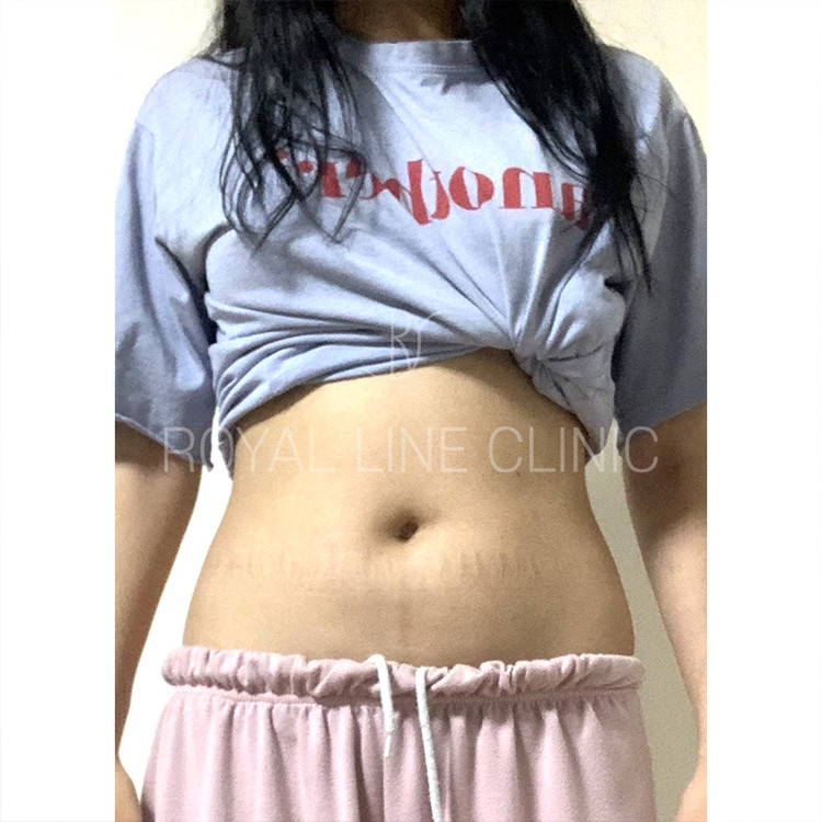 로얄라인의원 고객 무보정 리얼 셀피