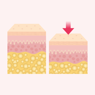 로트지방흡입 3단계 — 남은 지방까지 정리